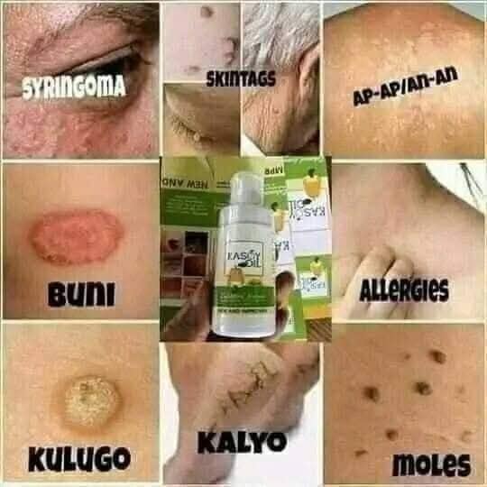 KASOY OIL FOR SKIN WARTS by angel touch