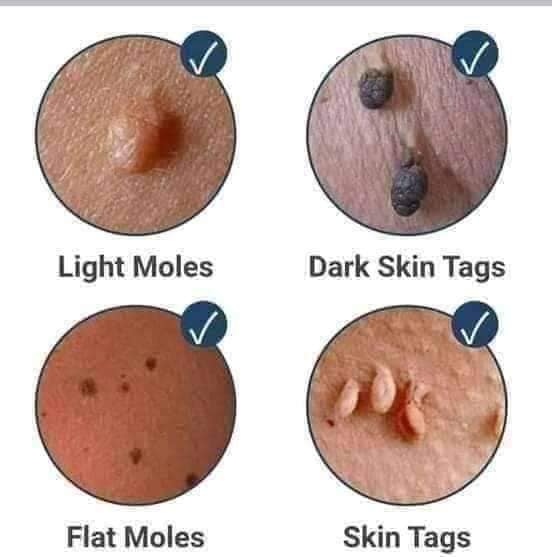 KASOY OIL FOR SKIN WARTS by angel touch