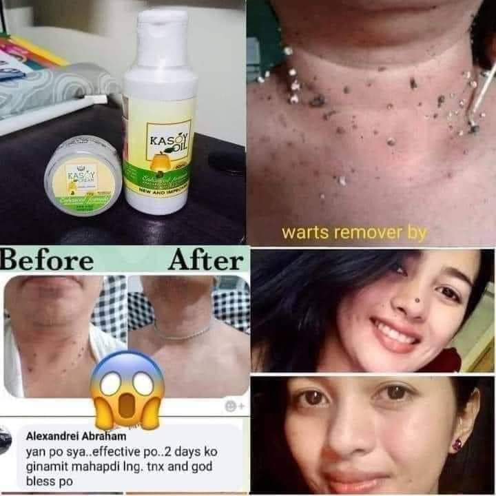 KASOY OIL FOR SKIN WARTS by angel touch